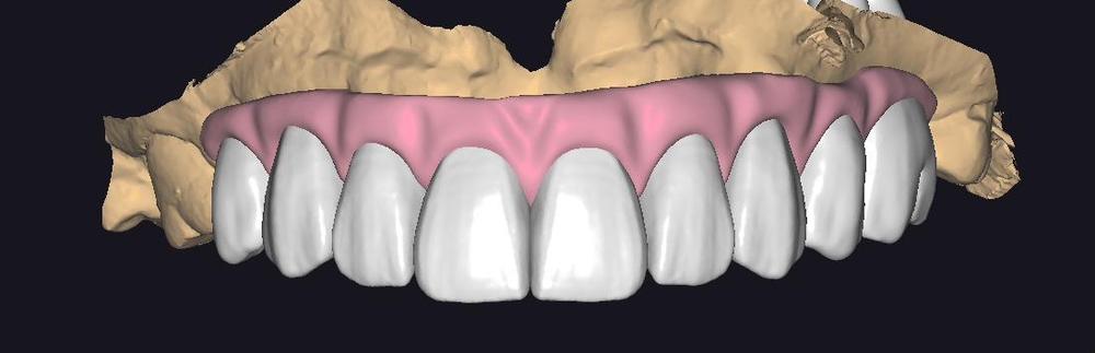Planejamento digital de protocolo no exocad, com a gengiva rosa sobre o modelo