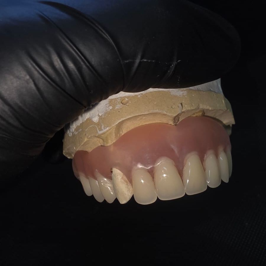 Prótese flexível superior sobre modelo de gesso, segurada com luva preta